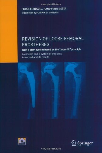 Revision of loose femoral prostheses with a stem system based on the "press-fit" principle: A concept and its system of implants, a method and its results (English Edition)